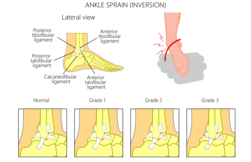 Ankle Sprain 